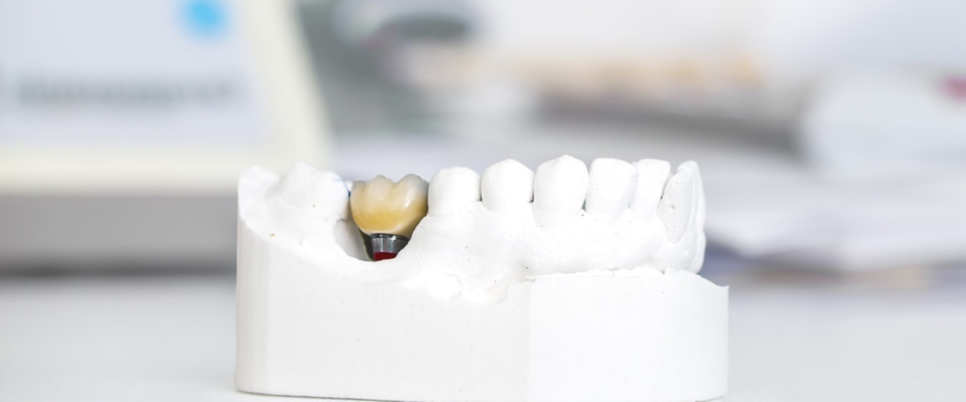 How Long Does It Take for Dental Implants to Fuse to Bone?