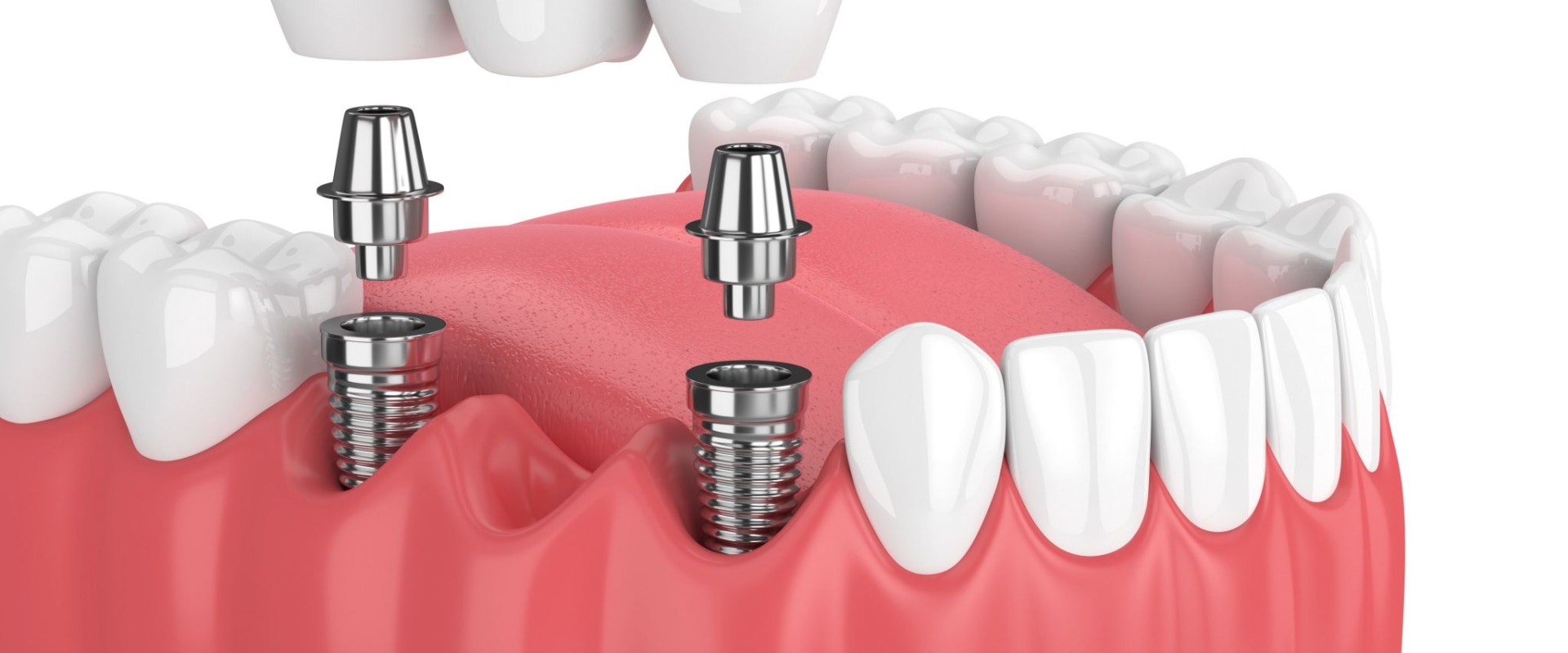 Is Tooth Implant Surgery Painful?