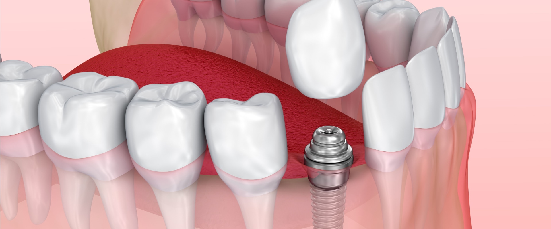 How Long Does Pain Last After a Tooth Implant Surgery?