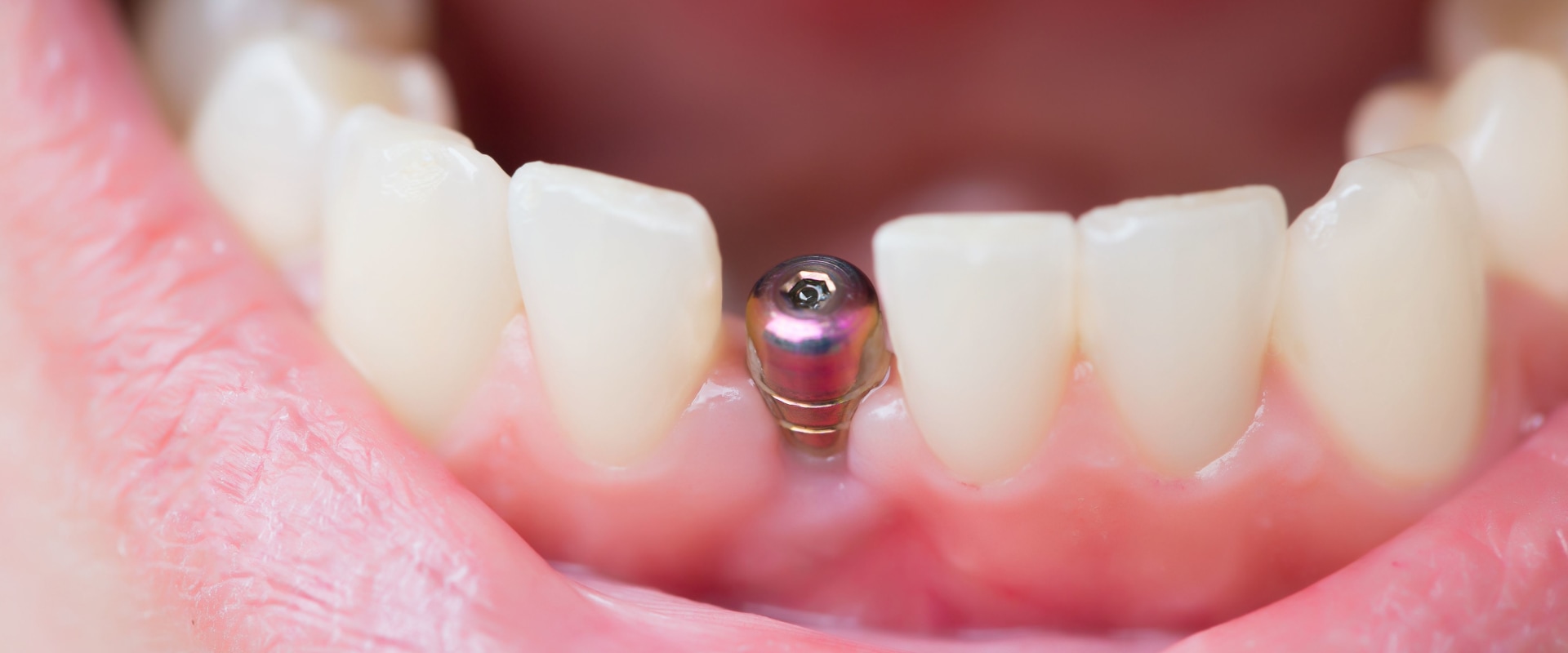 What to Expect the Day After Dental Implant Surgery