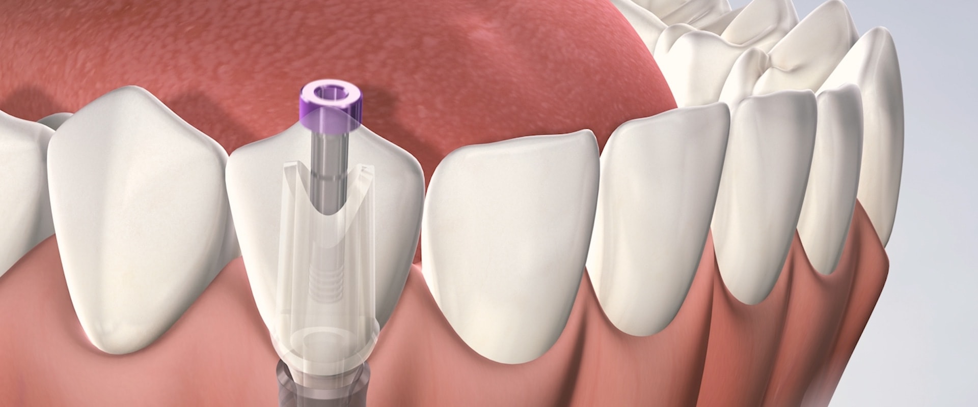 What to Expect After Getting Dental Implants: Pain, Recovery, and Follow-Up