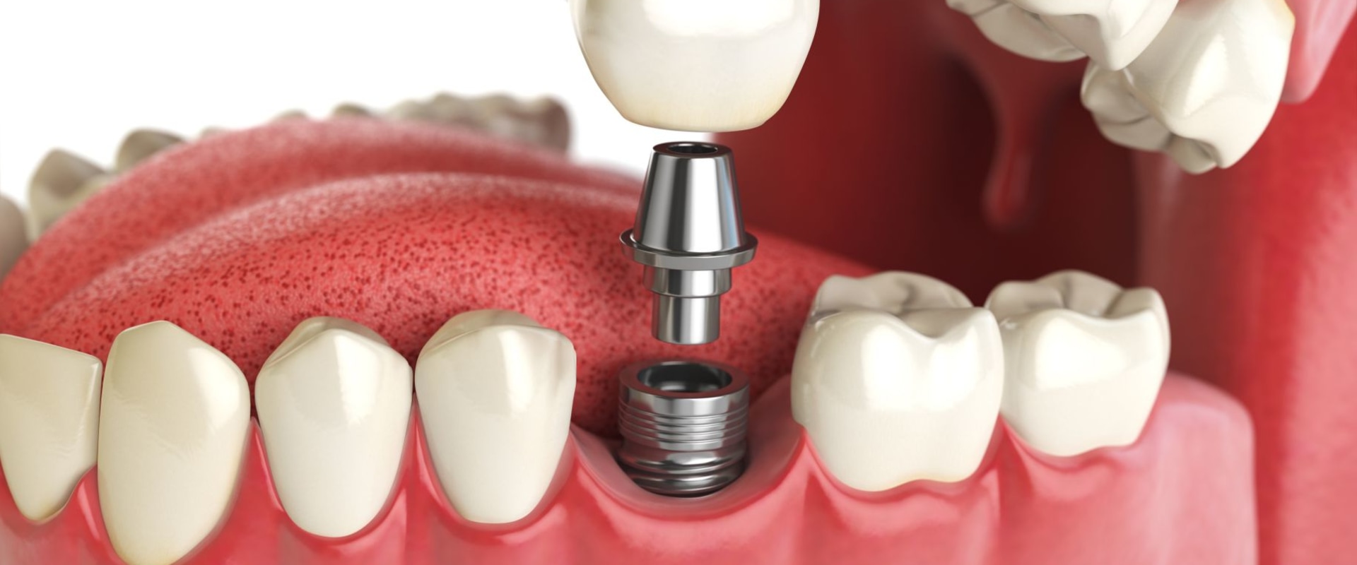 How Long Does a Dental Implant Take From Start to Finish?