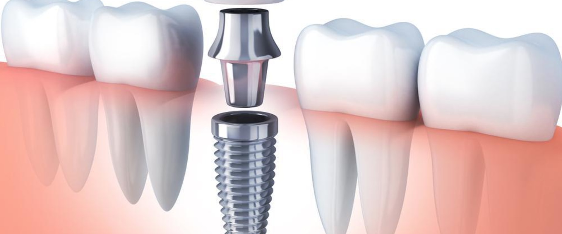 5 Things You Should Not Do After Dental Implant Surgery