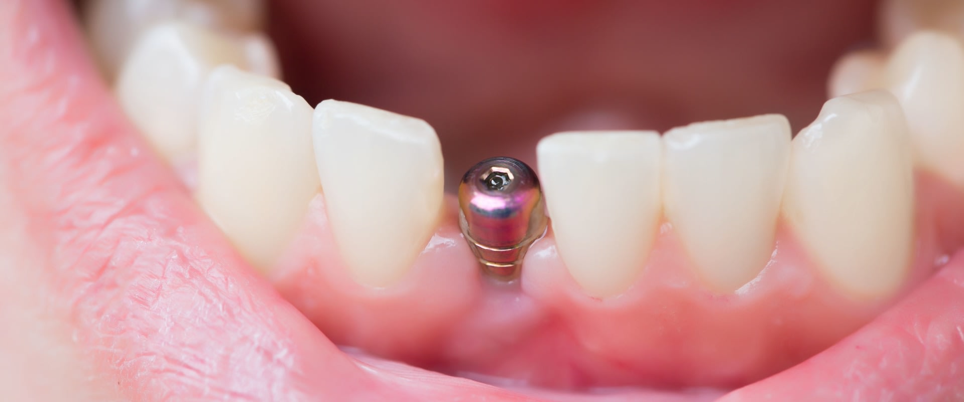 When Does Dental Implant Pain Peak? A Guide to Recovery