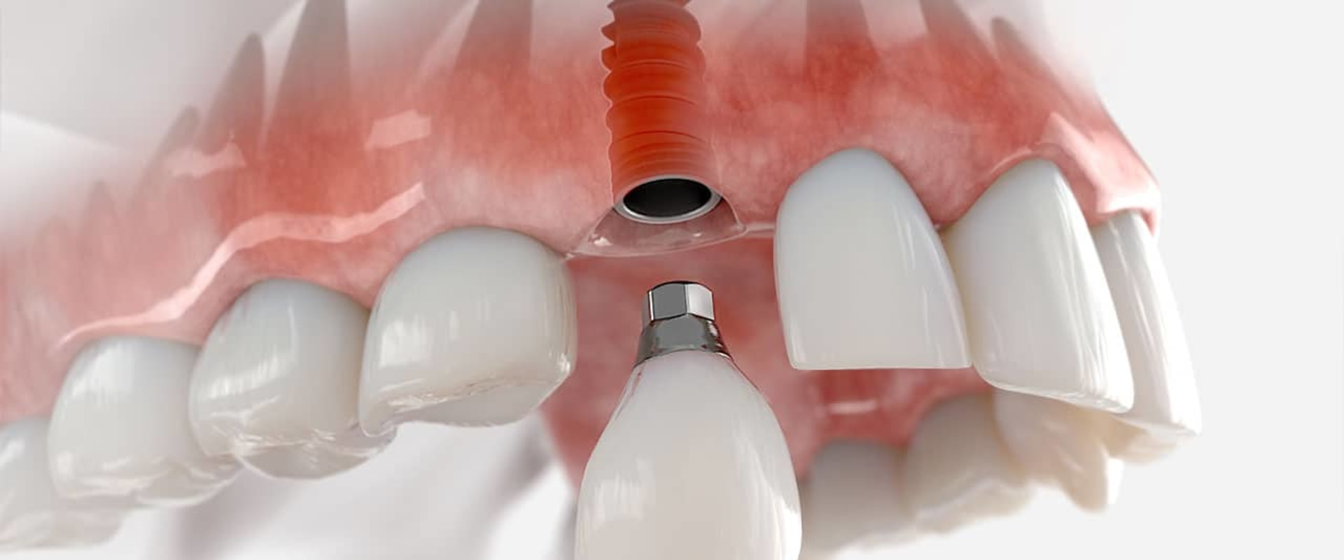 What to Expect After a Dental Implant Procedure