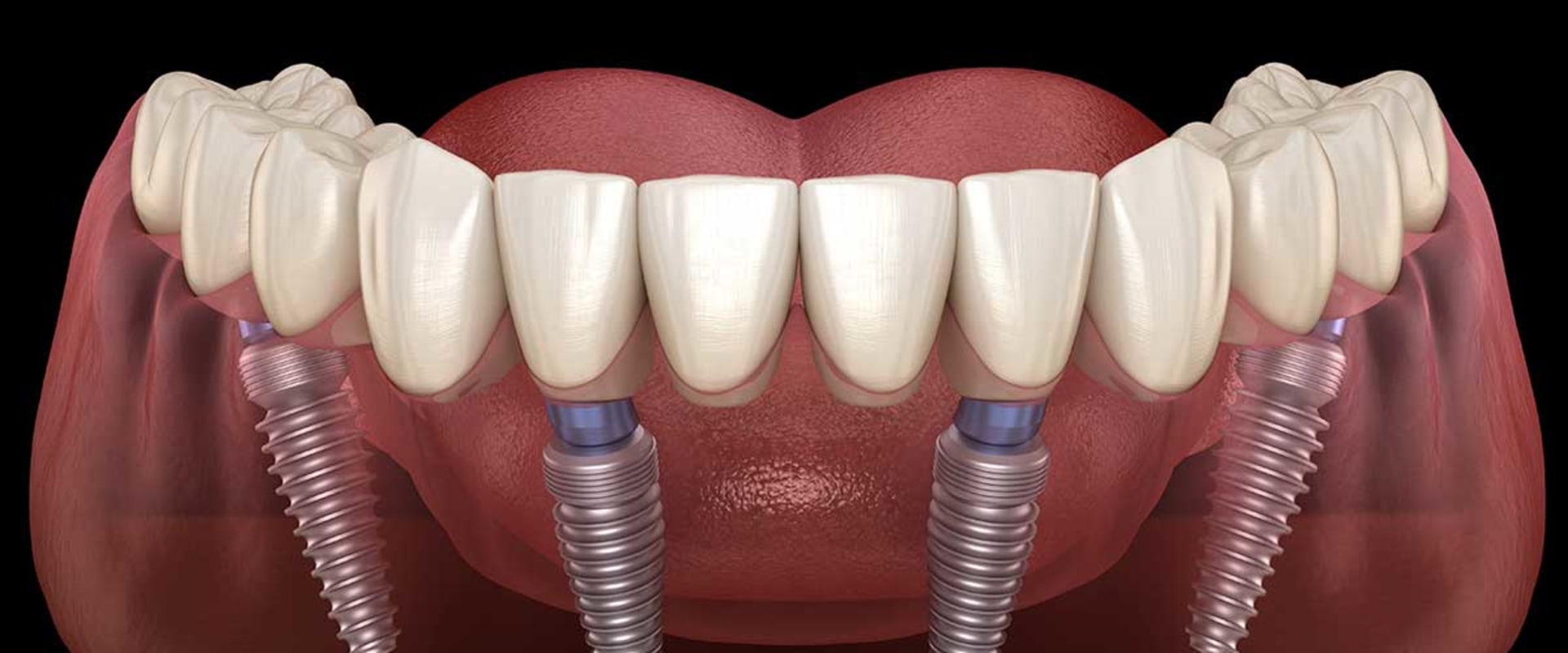 What Are All-on-4 Dental Implants and How Many Teeth Do They Replace?