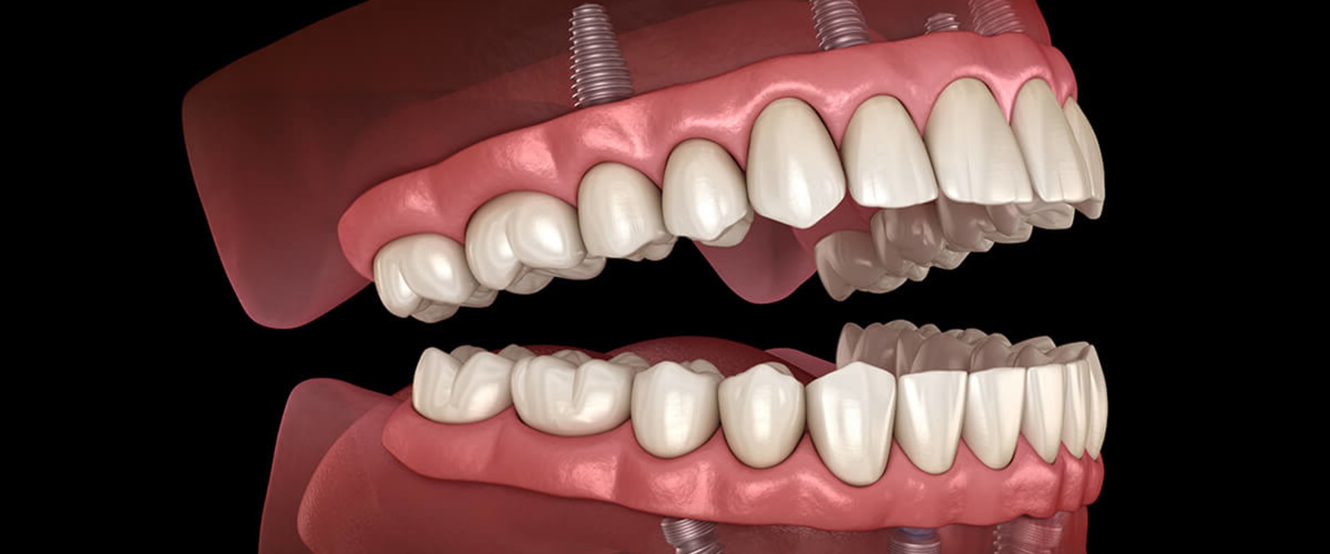 How Many Teeth Can Be Replaced with Dental Implants?