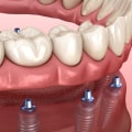 Can You Get a Dental Implant in One Day?