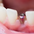 What to Expect Immediately After Dental Implant Surgery