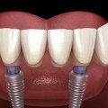 Who is Not a Candidate for All-on-4 Dental Implants?