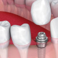 Can You Get a Dental Implant on the Same Day as an Extraction?