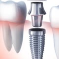 5 Things You Should Not Do After Dental Implant Surgery