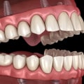 How Many Teeth Can Be Replaced with Dental Implants?