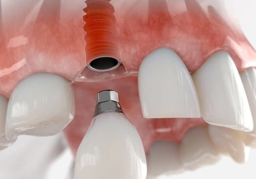 What to Expect After Getting a Dental Implant