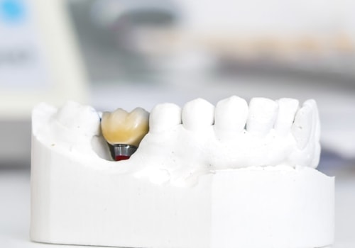 How Long Does It Take for Dental Implants to Fuse to Bone?