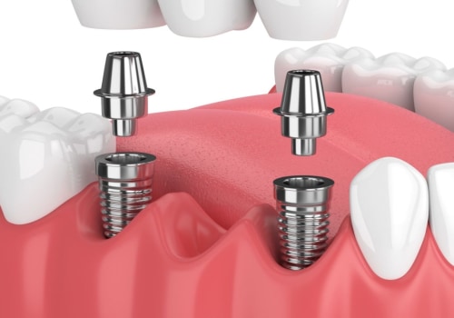 Is Tooth Implant Surgery Painful?