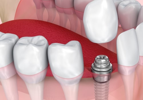 How Long Does Pain Last After a Tooth Implant Surgery?