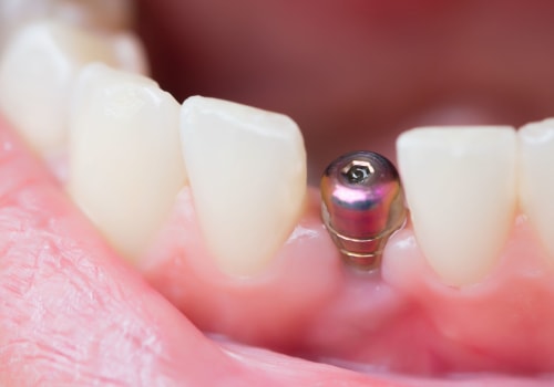 What to Expect the Day After Dental Implant Surgery