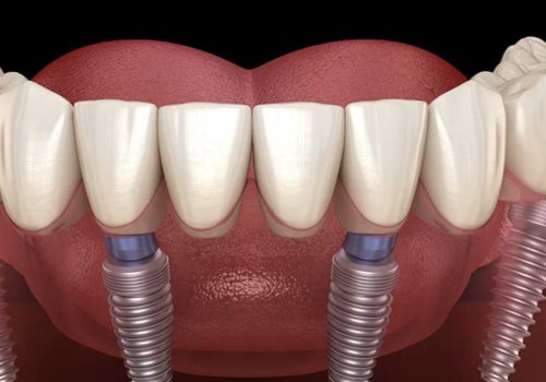 Who is Not a Candidate for All-on-4 Dental Implants?