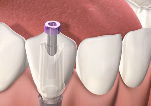 What to Expect After Getting Dental Implants: Pain, Recovery, and Follow-Up