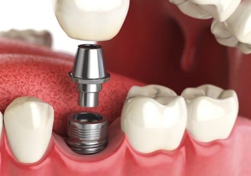 How Long Does a Dental Implant Take from Start to Finish?