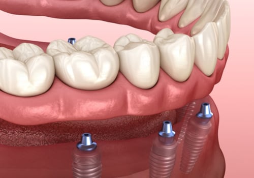 When Does Dental Implant Pain Peak? A Comprehensive Guide