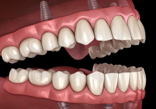 How Many Teeth Can Be Replaced with Dental Implants?