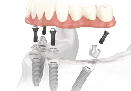 Who is a Good Candidate for All-on-Four Dental Implants?